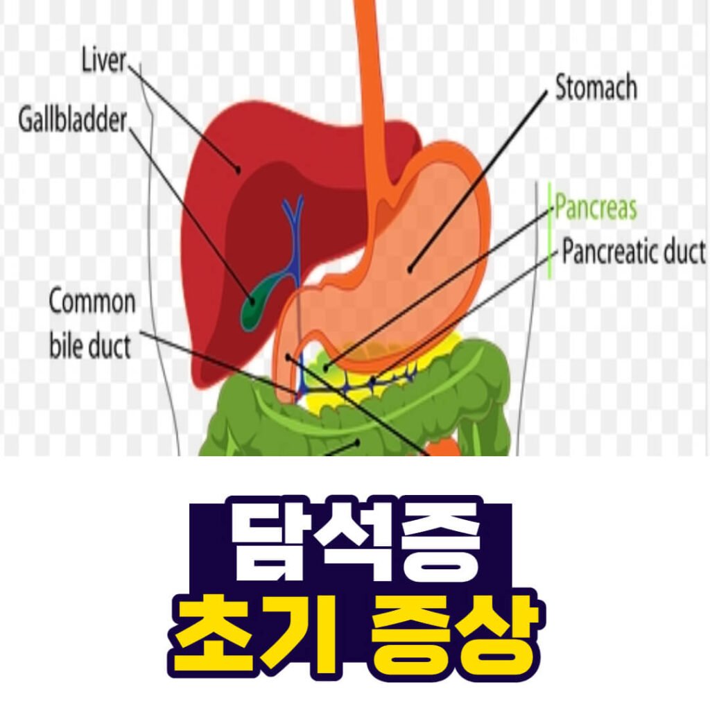 담석증 초기 증상